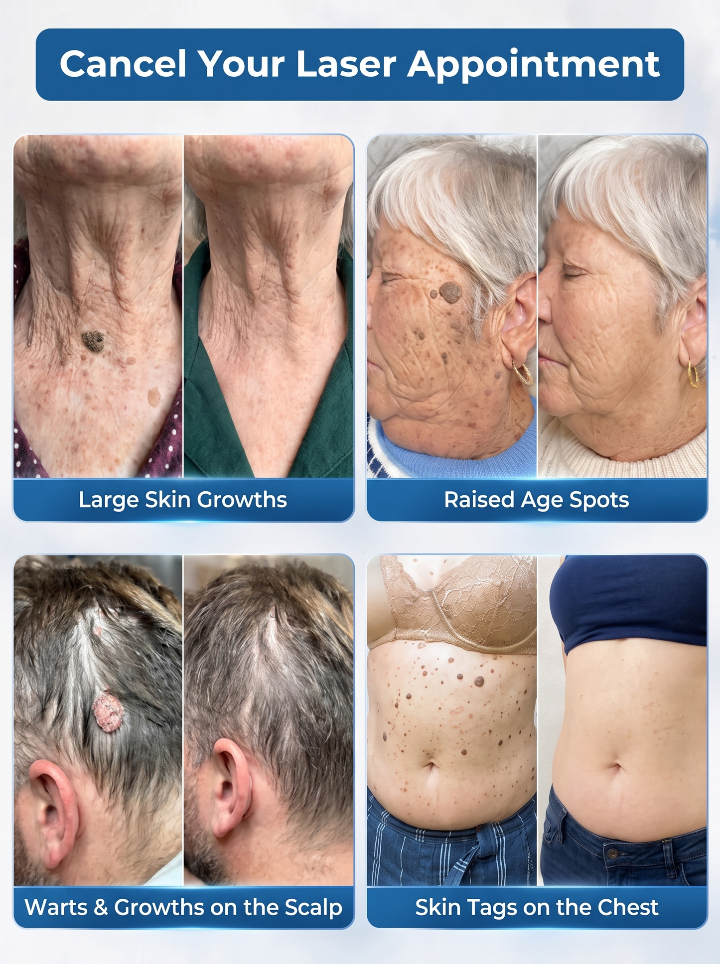 DermaErase™ – Precision Roll-On for Warts, Skin Tags & Skin Blemishes