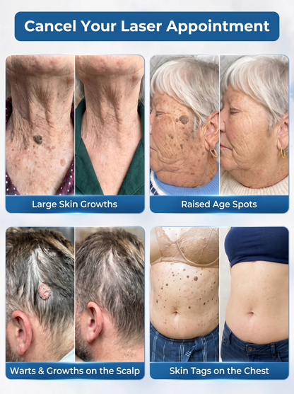 DermaErase™ – Precision Roll-On for Warts, Skin Tags & Skin Blemishes