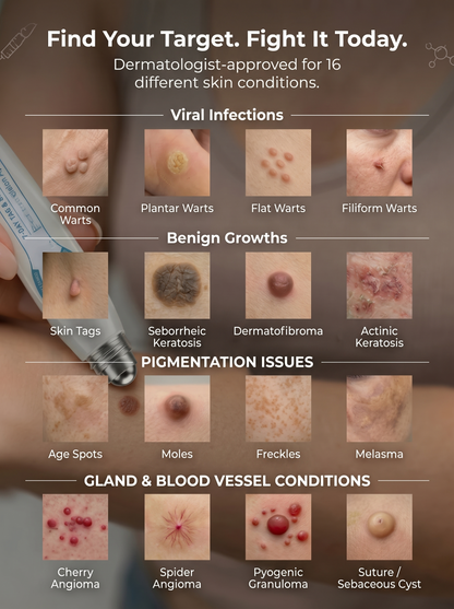DermaErase™ – Precision Roll-On for Warts, Skin Tags & Skin Blemishes